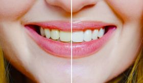 Dental Implant & Teeth Cleaning - Discount