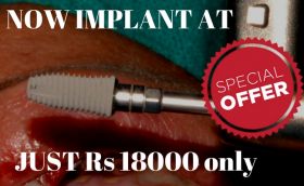 dental implant offer