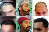 PRP Hair Fall Therapy | Hair Loss Treatment in Ludhiana,Punjab,India - Ludhiana Hair Studio