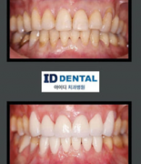 ID Dental Implant and Dental Care