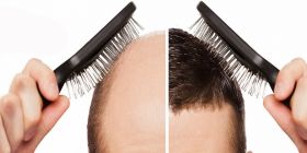 Athena Hair Now - Hair Transplant in Chanidgarh, India