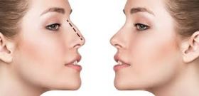 Rhinoplasty in Dubai