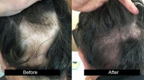 AG Clinics - Hair Transplant in Jalandhar