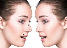 Rhinoplasty in Dubai