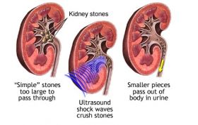 KidneyStoneTreatment.In