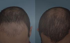 GameDay Men's Hair Replacement