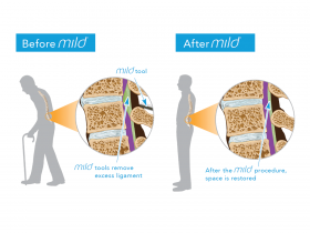 Mild Procedure Lakewood