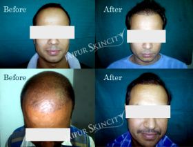 Jaipur Skin City - Hair Transplant