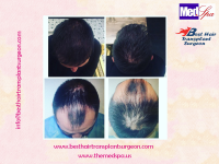 Best Hair Transplant INDIA