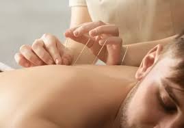 Acupuncture Natural Healing