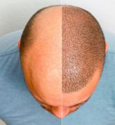 Micropigmentation Rive-Sud