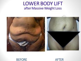  Best Body Lift Surgery India