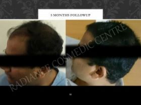  Radiance Cosmedic Centre | Cost of hair transplant in Delhi 