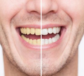 Teeth Whitening Clinic Dubai