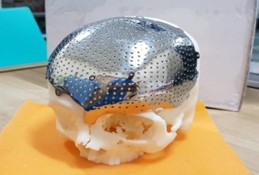 Titanium Cranial 3D printed  Implants for Craniopl