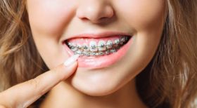 Braces Treatment in Bandra West