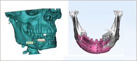 Maxillofacial Reconstruction, Maxillofacial Design