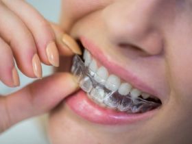 Aligners
