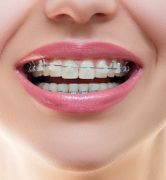 Ceramic Braces in Dubai