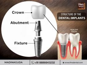 Dental Implants