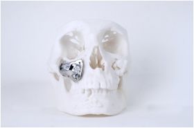 Patient Specific Implants by 3D Incredible