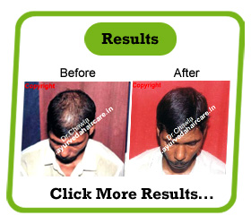 Alopecia universalis