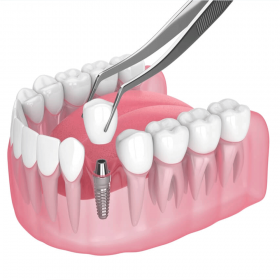 Dental Implant & Products