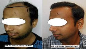 Hair Transplant Clinic in Mumbai