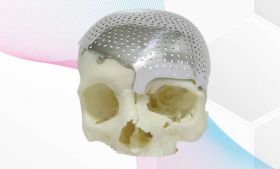 Skull Reshaping, Cranial reshaping by 3d Printed t