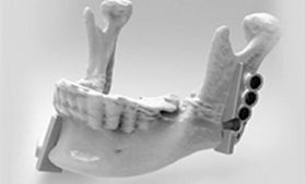 3D Printed Mandible