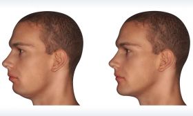 Jaw Deformity Treatment in Dubai