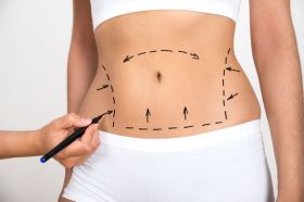 Laser Liposuction