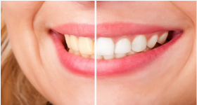 Affordable Laser Teeth Whitening Cost