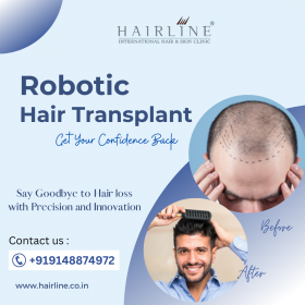 Get a permanent solution to hair loss with #Roboti