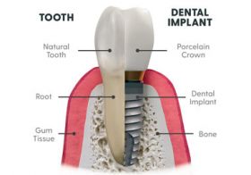 Dental Implants 