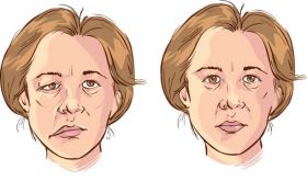 Bell’s Palsy / Facial Paralysis