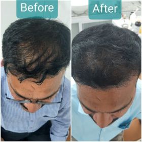 Hair Transplant