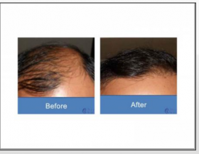 Hair Transplantation Surgery 