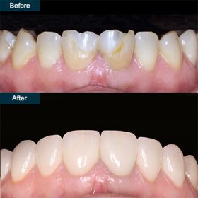 Dental Veneers in Brooklyn 