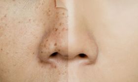  Skin Pigmentation Treatment