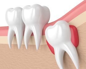 Dental Clinic in Madinaguda and Kondapur Hyderabad