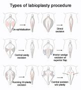 Labiaplasty - Brooklyn, NY 