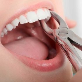 Tooth Removal in Dubai 