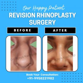 Revision Rhinoplasty Surgery