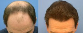 FUE Hair Transplant