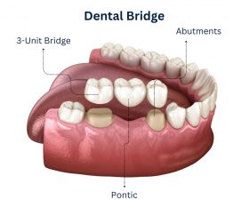 Dental bridges