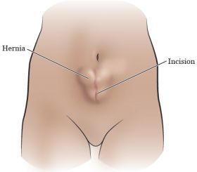 Hernia Surgery