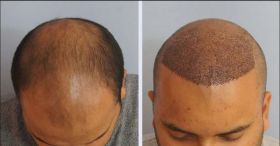 Hair Transplant