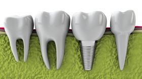 Dental Implants