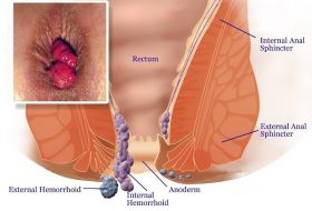 Hemorrhoids | Piles Treatment